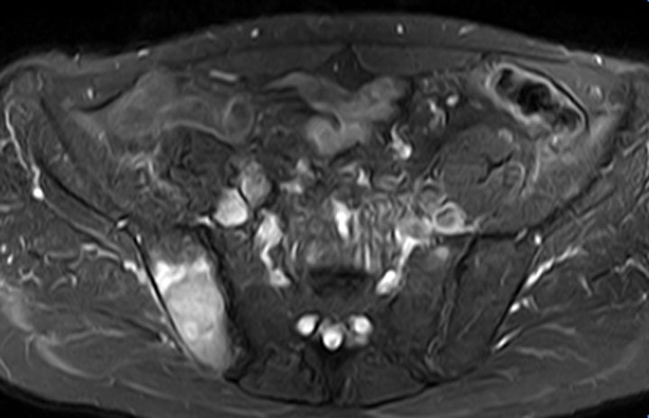 ProCAncer-I-newsletter-4-03